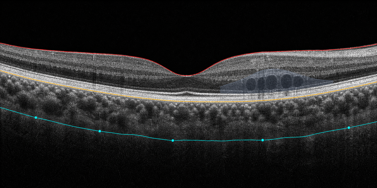 OCT-Beispiel mit retinalen Grenzlinien und Läsionen